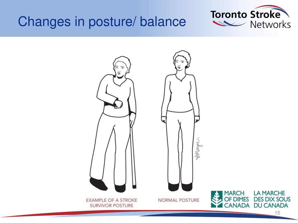 - A common posture or walking pattern we see after a stroke.
